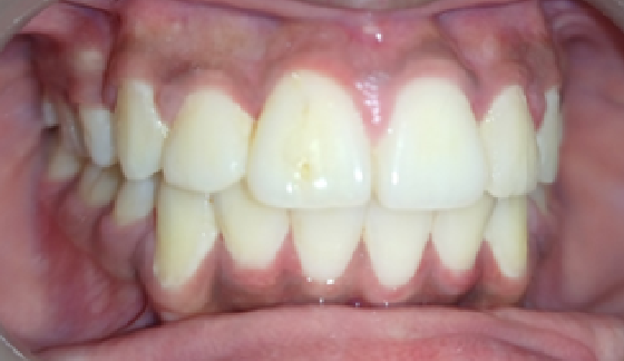 After dental transformation 13