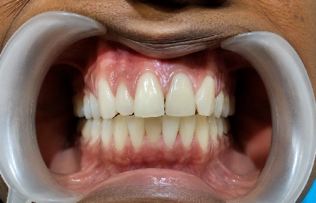 After dental transformation 9
