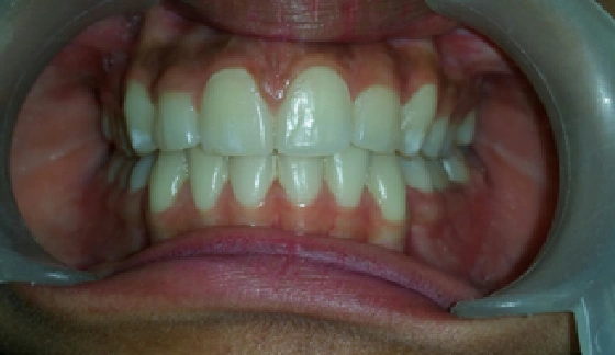 Ortho Braces – after