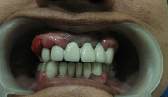 Gum Surgery â€“ after