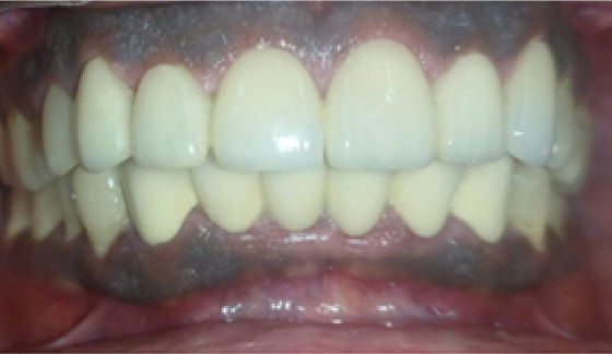 Smile Makeover â€“ after