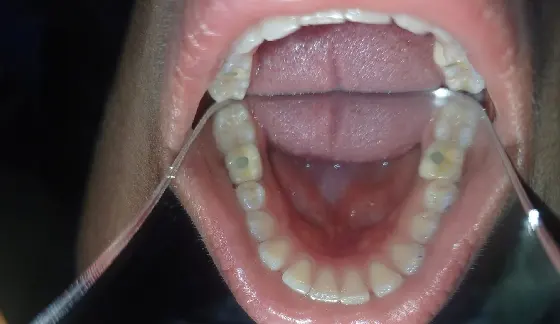 Dental Implants â€“ after