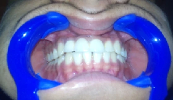 After dental transformation 11