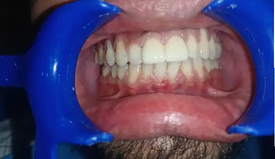 After dental transformation 14