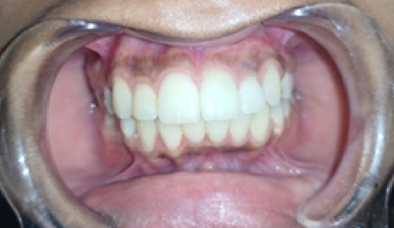 After dental transformation 18