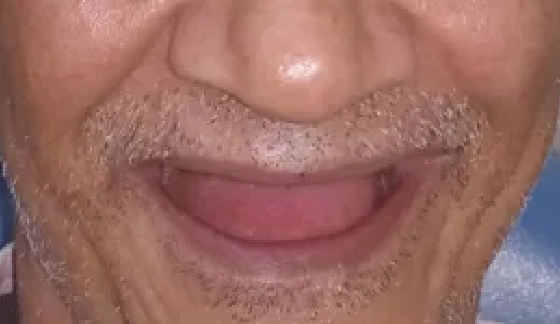 Dentures â€“ before