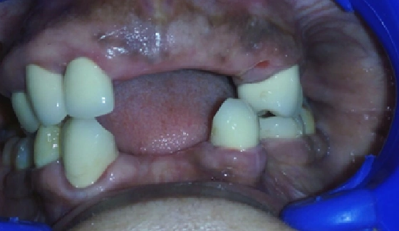 Gum Surgery â€“ before