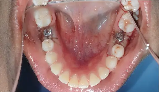 Dental Implants â€“ before