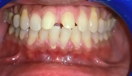 Before dental transformation 14