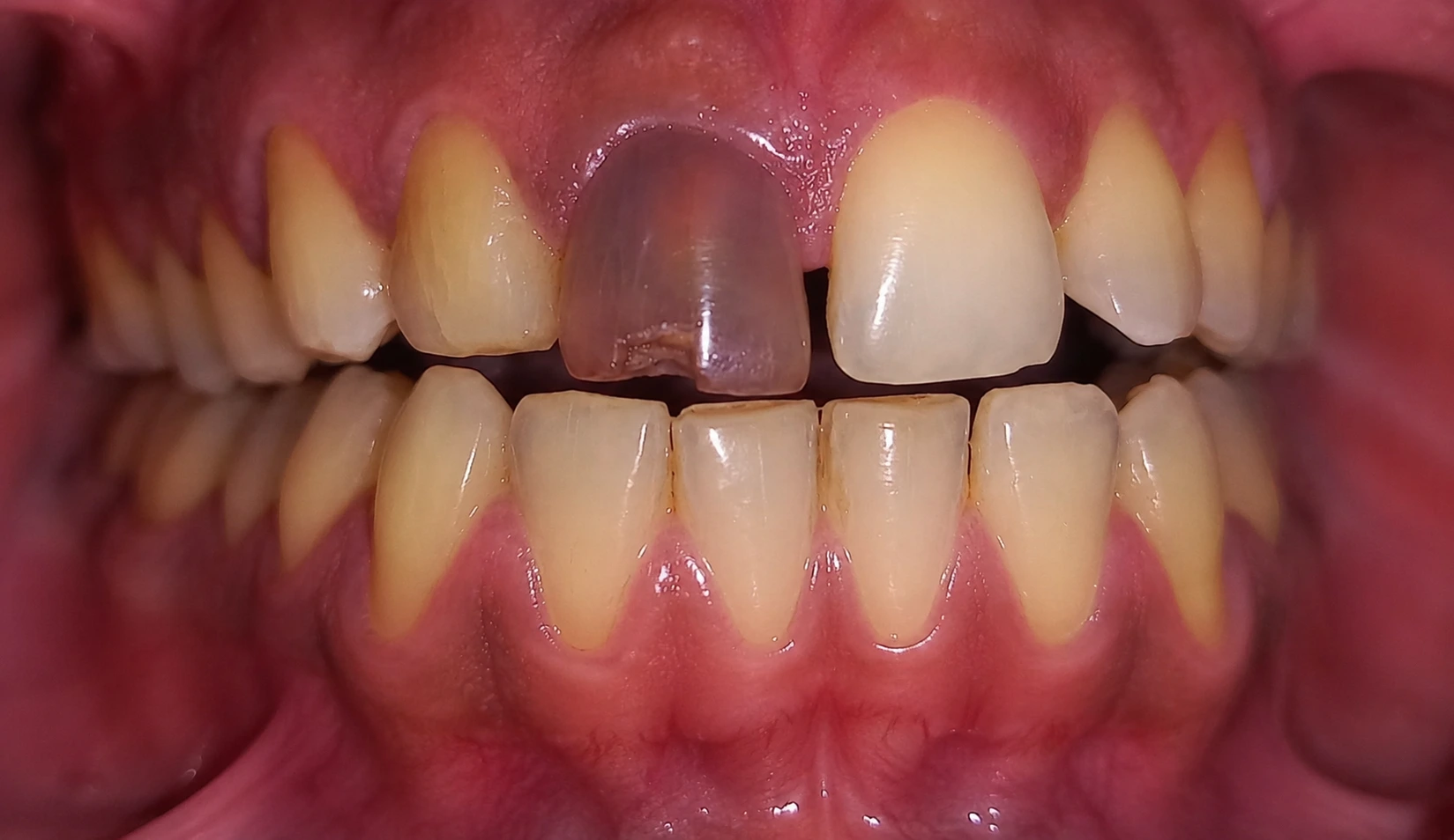 Bleaching / Teeth Whitening - before