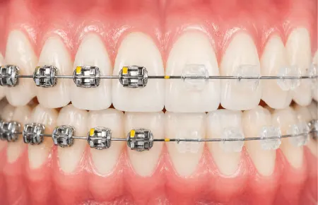 Ortho Braces