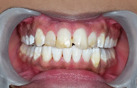 Dental Veneers - before