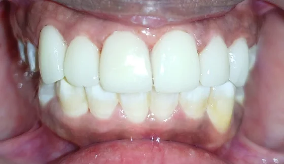 Dental Veneers â€“ after