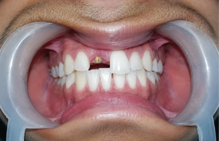 Dental Crowns and Bridges – before