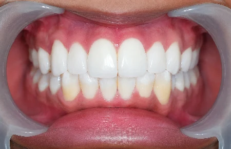 Dental Veneers - after