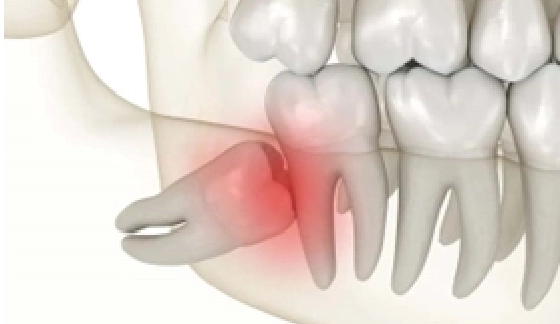 Tooth Impaction – after