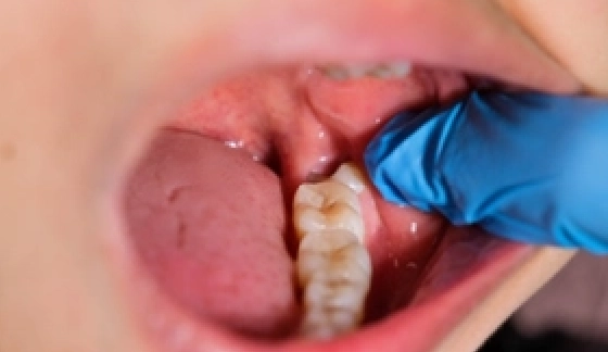 Tooth Impaction – before