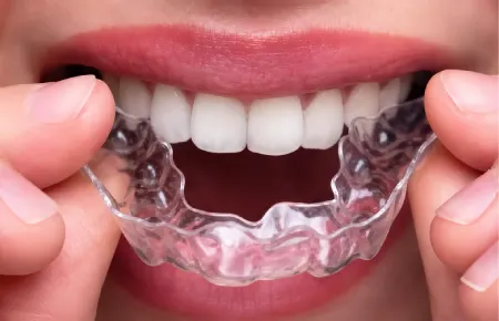 Mouth Guard
