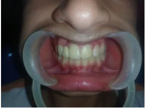 After dental transformation 2