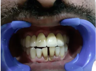 After dental transformation 5