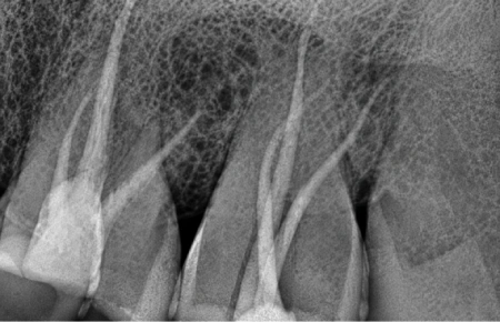 Root Canal Treatment - after