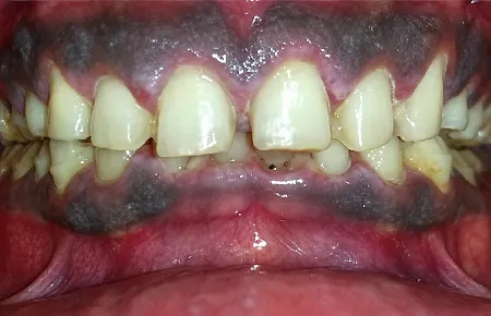 Smile Makeover - before