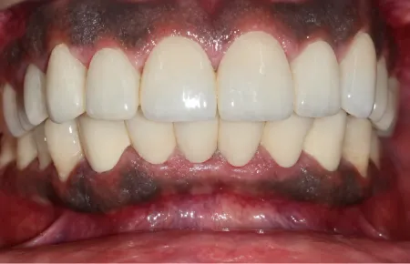 Smile Makeover - after