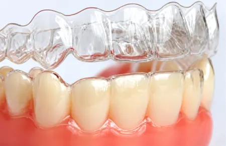 Tooth Invisalign