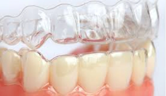 Tooth Invisalign - after