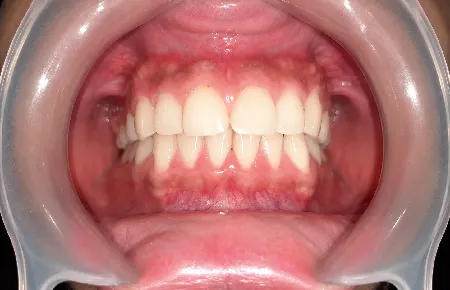 Tooth-Coloured Fillings – after