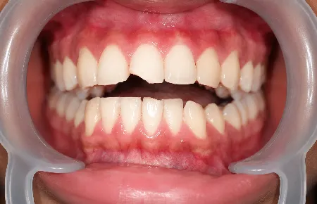Tooth-Coloured Fillings – before